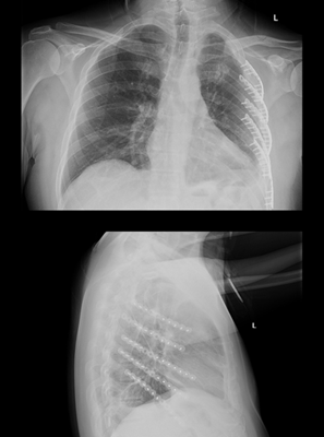 chest wall trauma